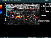 ileitis in yersiniosis 