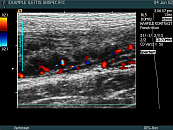 unspecific ileitis