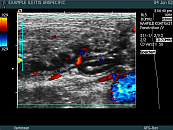 unspecific ileitis and vermiform appendix